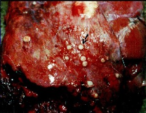 7 Lesions (also called tubercles or abscesses) on the surface of a wild deer lung. The arrow points to one of the pea-sized lesions.